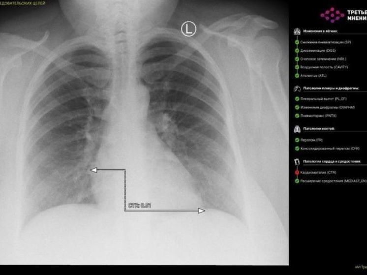 В Башкирии ИИ впервые расшифровал рентгеновский снимок