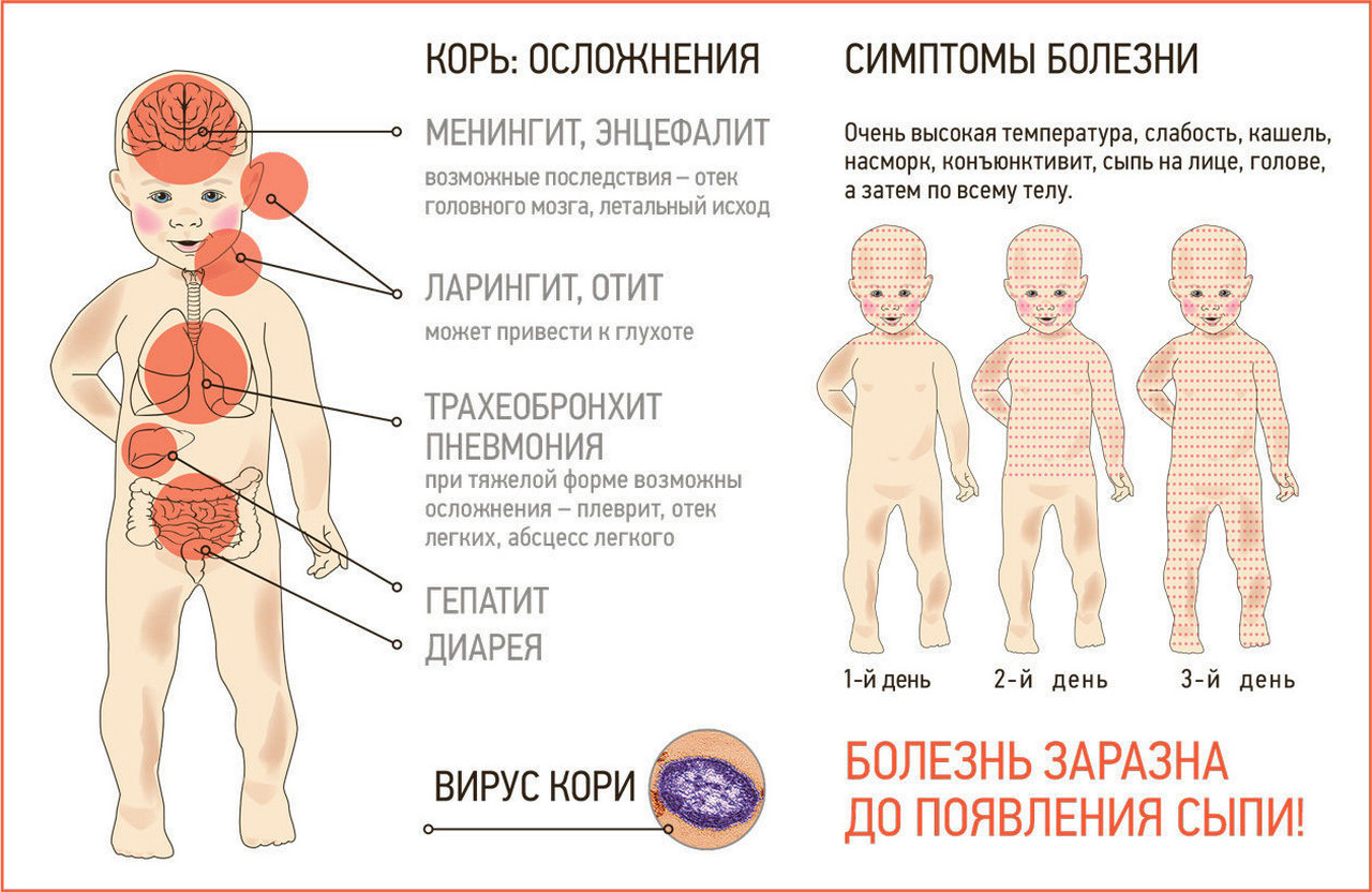 Можно ли кори. Вирусная экзантема и розеола. Осложнения от прививки от кори у детей.