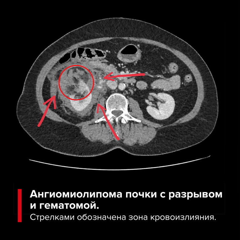 Ангиомиолипома правой. Множественные ангиомиолипомы почек кт. Ангиомиолипома правой почки что это такое.