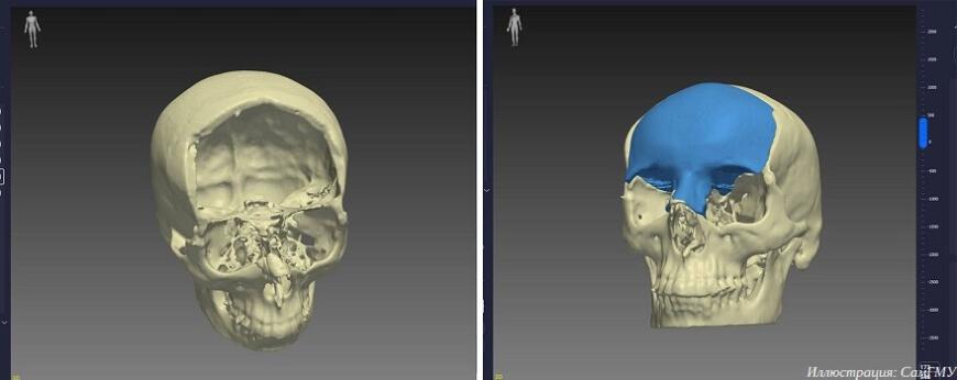 СамГМУ использует 3D-печать в производстве пресс-форм для изготовления черепных имплантатов
