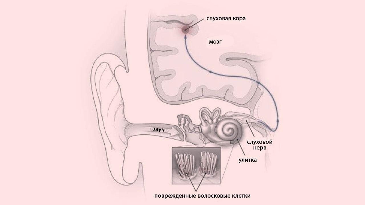 Слышим звон да не знаем где он. Тиннитус схема формирования. Notch терапия тиннитус. Тиннитус 911. Tinnitus Aurium это.