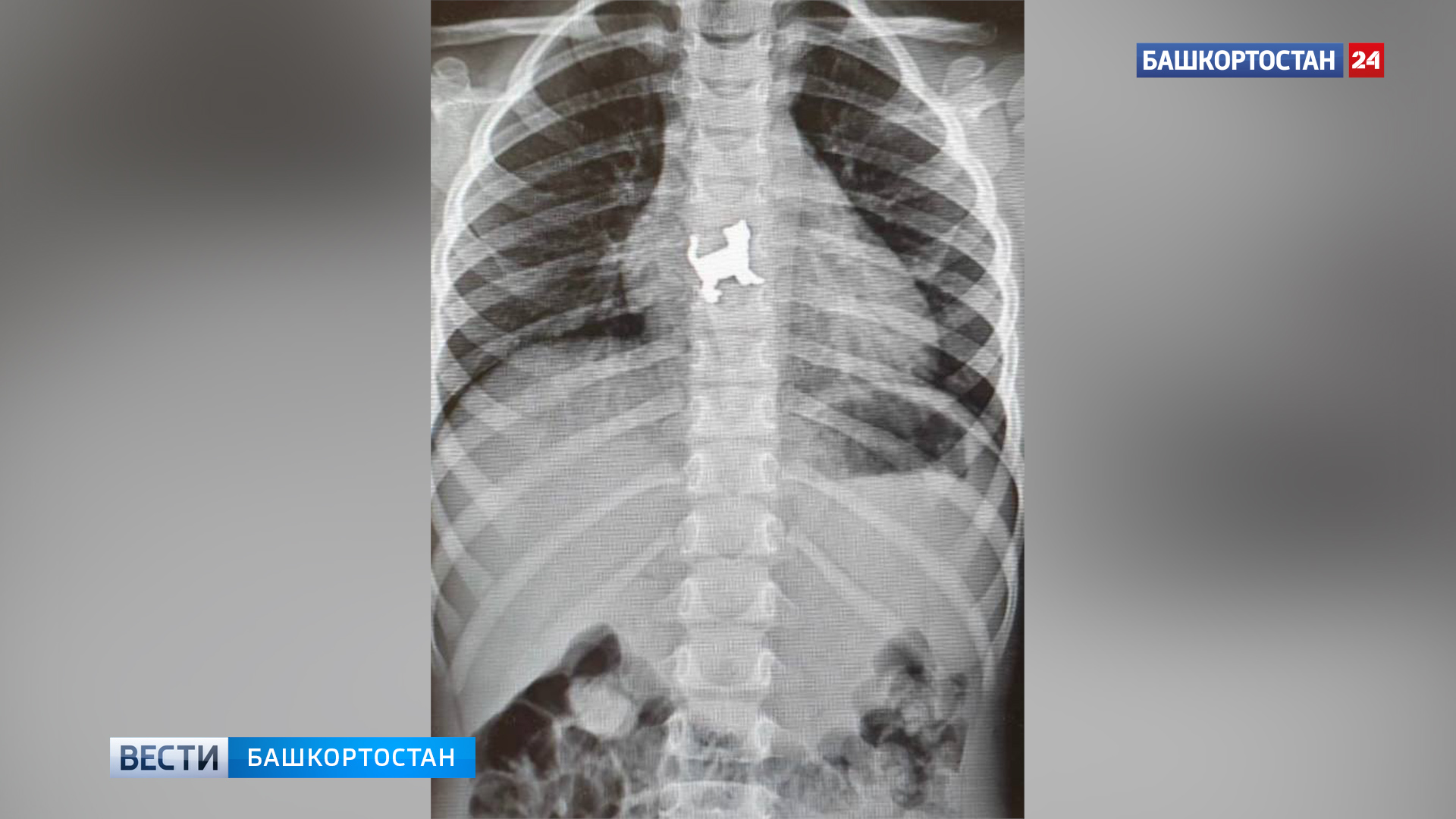 В Уфе хирурги спасли 3-летнюю девочку, которая проглотила металлическую игрушку в форме кошки | 0