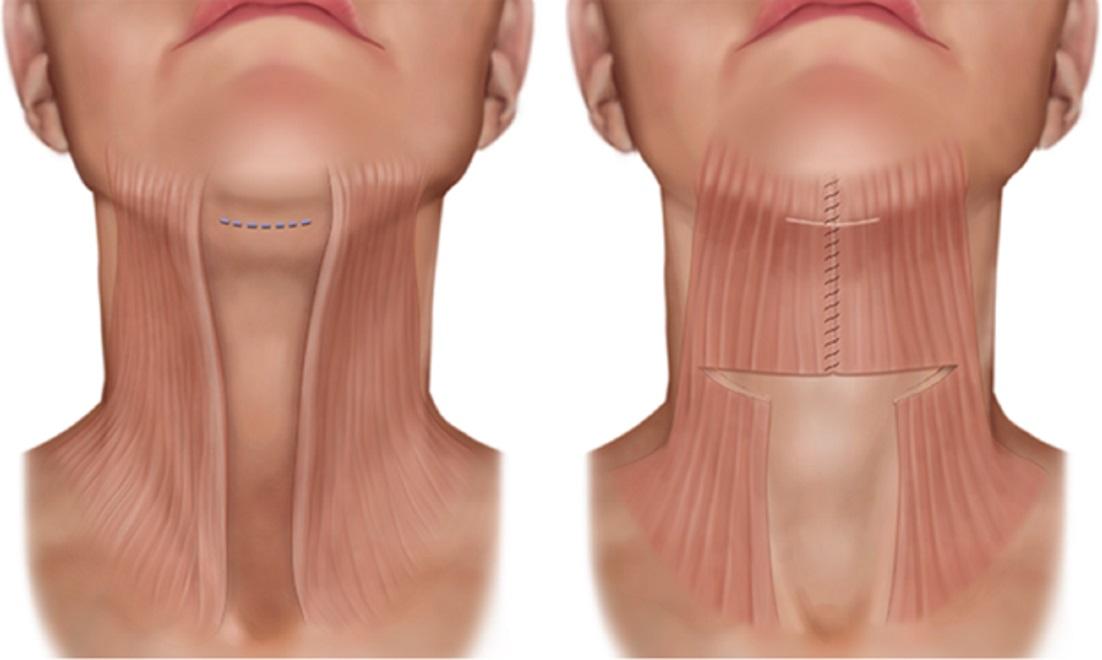 Шея это. Платизмопластика (пластика шеи). Латеральная платизмопластика. Медиальная платизмопластика. Платизмопластика Ибрагимов.