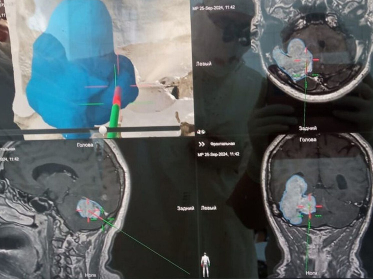 Новокузнечанину удалили гигантскую опухоль головного мозга