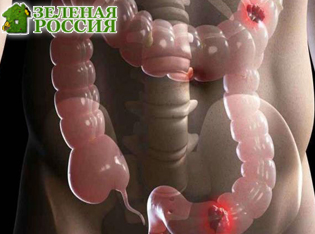 Сальмонелла с «самоуничтожением» повышает выживаемость при раке кишечника