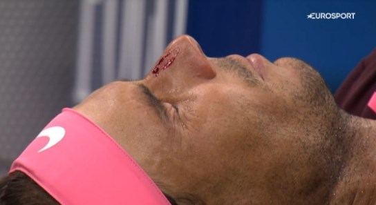 Рафаэль Надаль разбил нос, но вышел в 1/16 финала "US Open&quo...