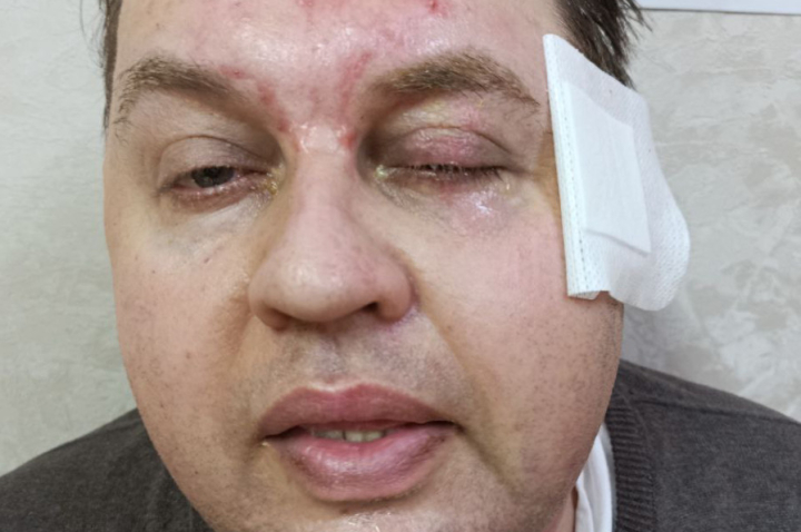 Игорь Ронжин после проведения нескольких операций.