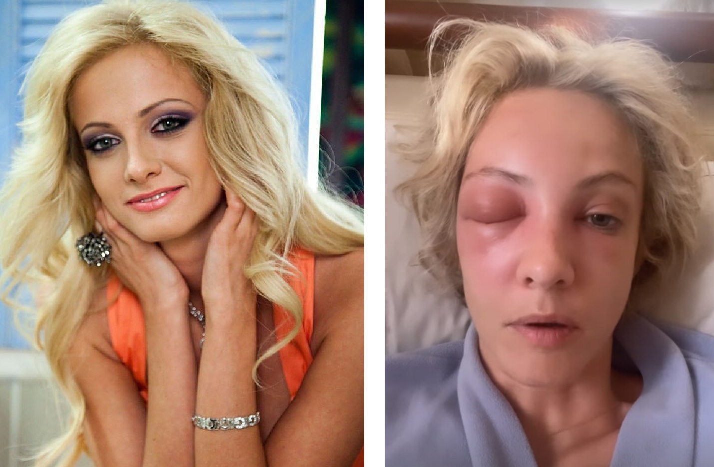 Полина максимова пластика до и после