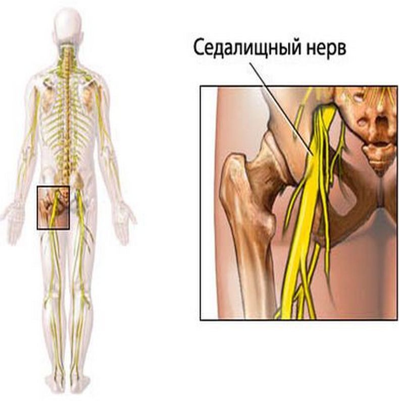 Неврит бедренного нерва лечение. Воспаление сидальческого нерва. Невропатия бедренного нерва. Сидальческий нерв лекарство.