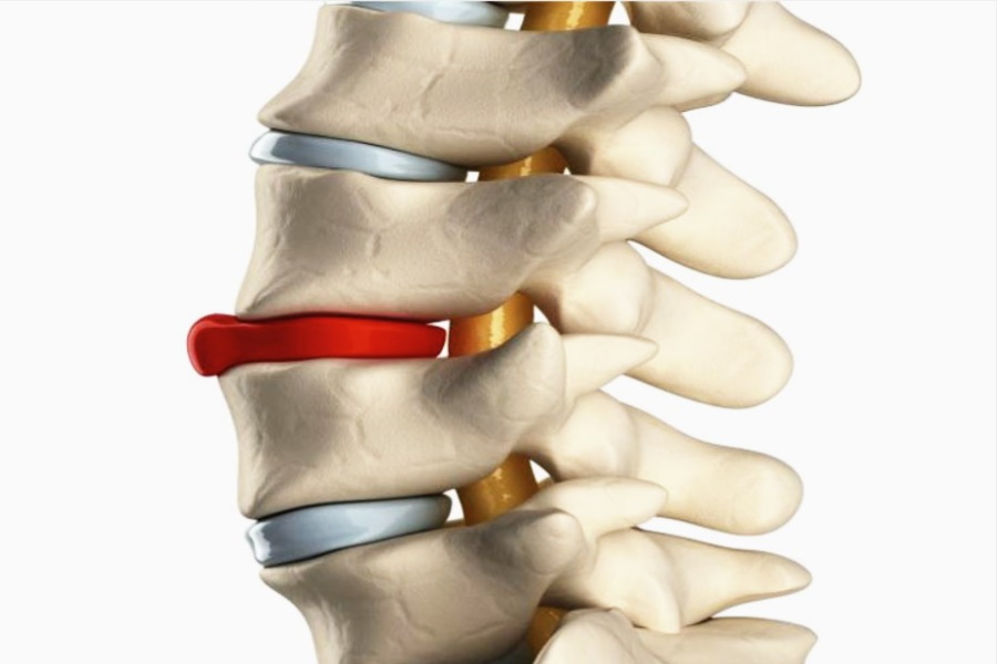 Что такое грыжа позвоночника фото