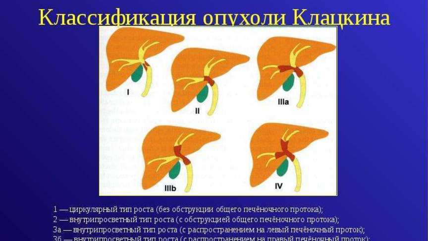 Опухоль Клацкина: лечение и диагностика | Здоровье | Селдон Новости