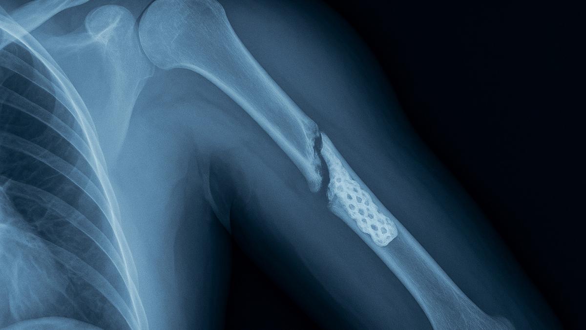 Рентген с 3D-имплантатом