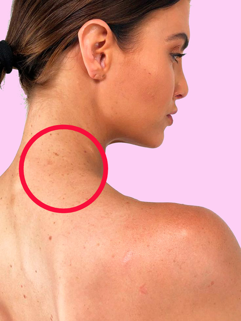 Кератомы причины возникновения лечение фото How to get rid of pigmentary spots and keratomas Lifestyle Seldon News