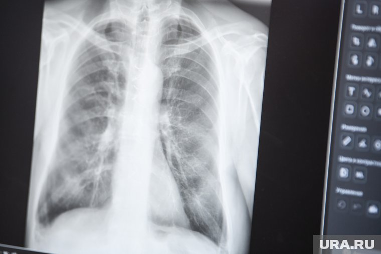 Рак легкого занимает первое место среди причин смертности от онкозаболеваний