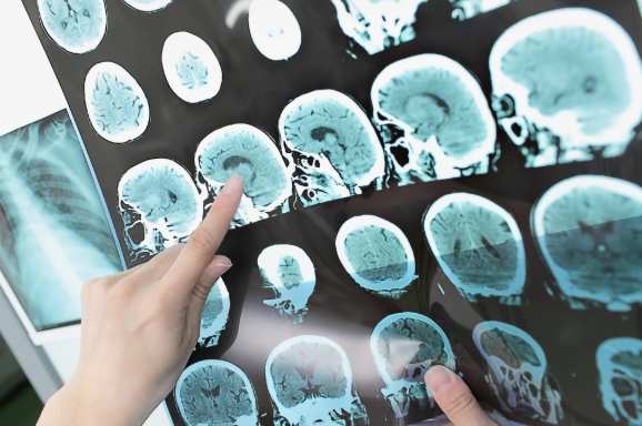 Болезнь молодых: в России стремительно растёт число пациентов с рассеянным склерозом | Русская весна