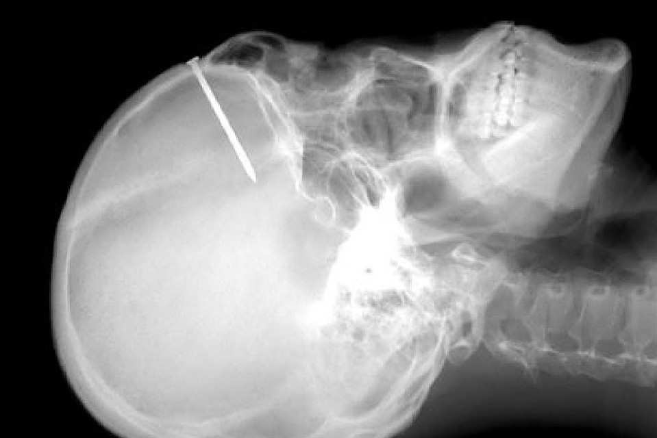 В России создали гель для восстановления костей со 100% идентичностью