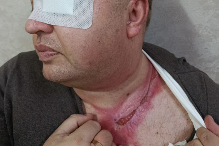 Игорь Ронжин после проведения нескольких операций.