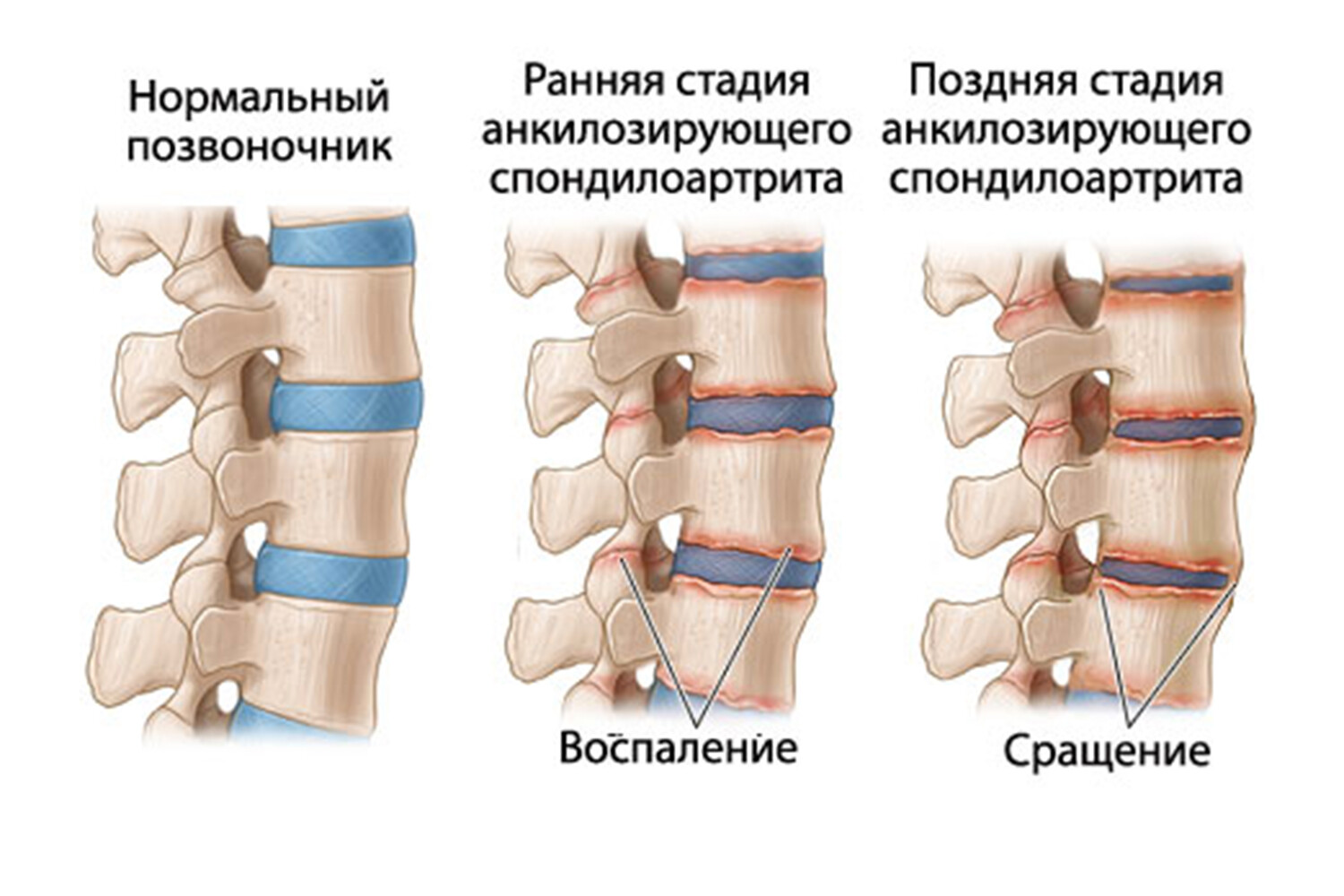 Анкилозирующий спондилит болезнь Бехтерева