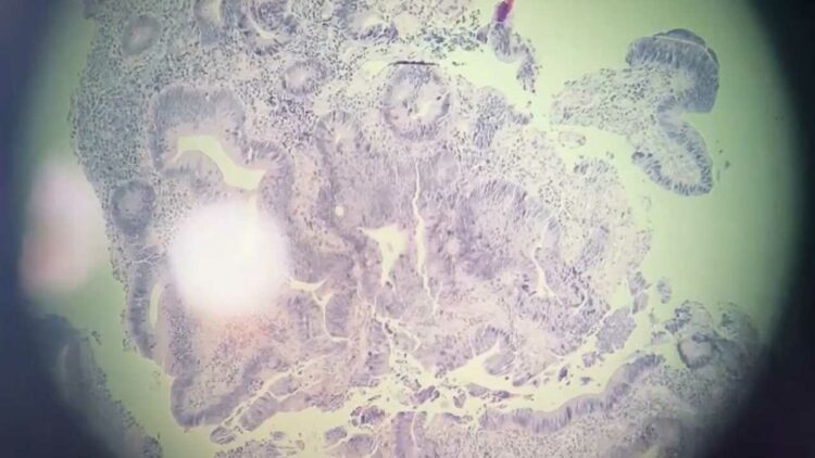 Как выглядит раковая опухоль фото под микроскопом In oncology dispensary of Boats showed how cancer cells look Health Seldon News