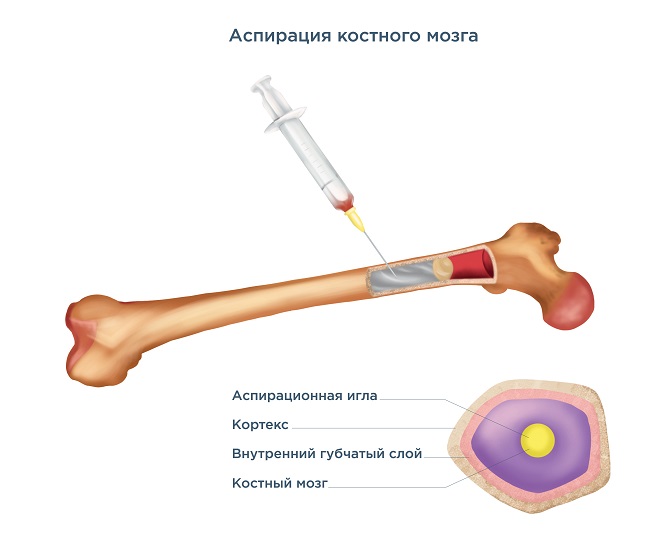 Пункция костного мозга картинки