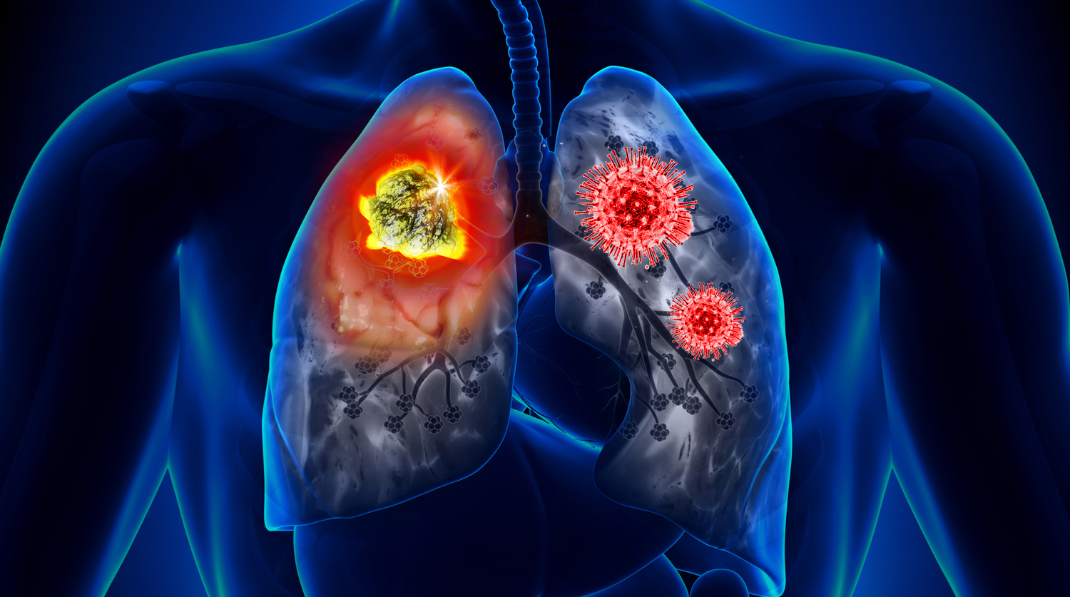 Cancer de pulmon neumonia