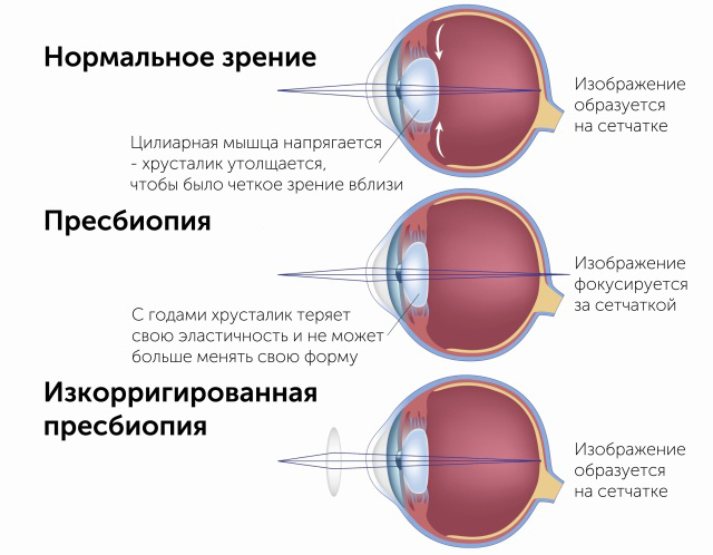 Дефект зрения при котором изображение формируется не на сетчатке глаза