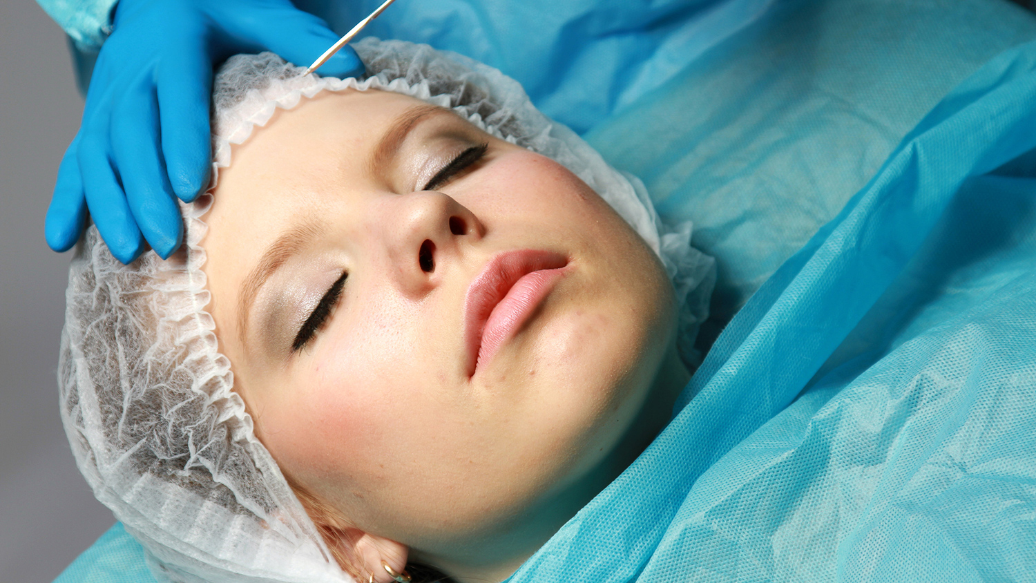 техника бионити в косметологии. платизмопластика ботоксом. пластический хирург. пластическая хирургия пейпл. пластическая хирургия лица.