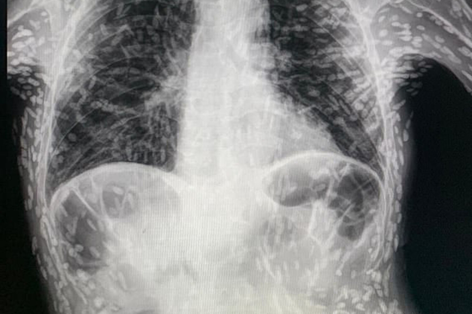 силиконовая грудь на рентгене фото 53
