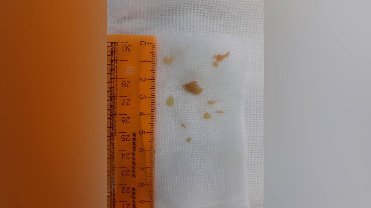 Кусочки яблока из трахеи и бронхов двухлетнего мальчика достали липецкие врачи 