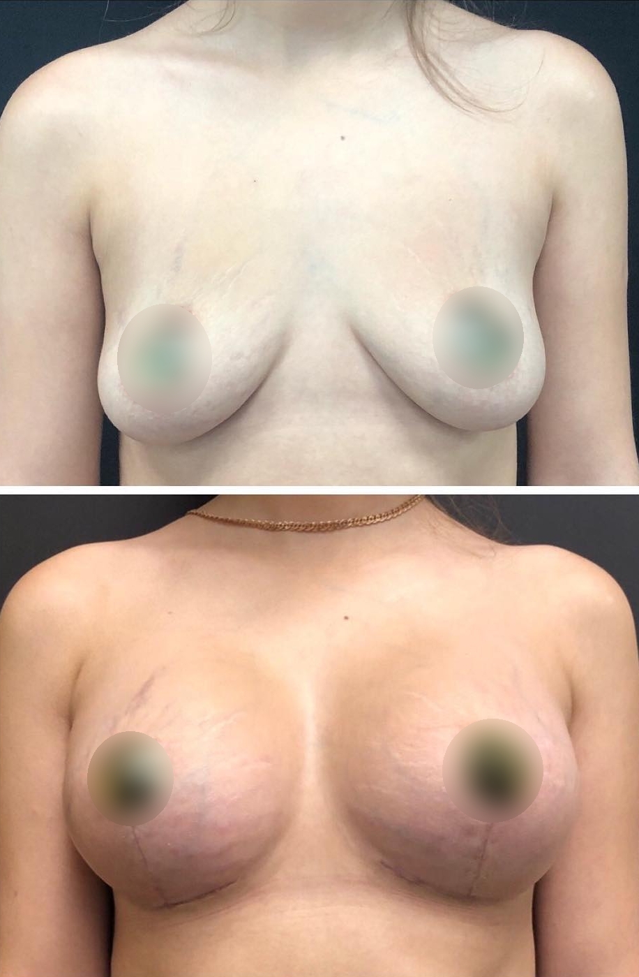уменьшение размера груди операцией фото 104