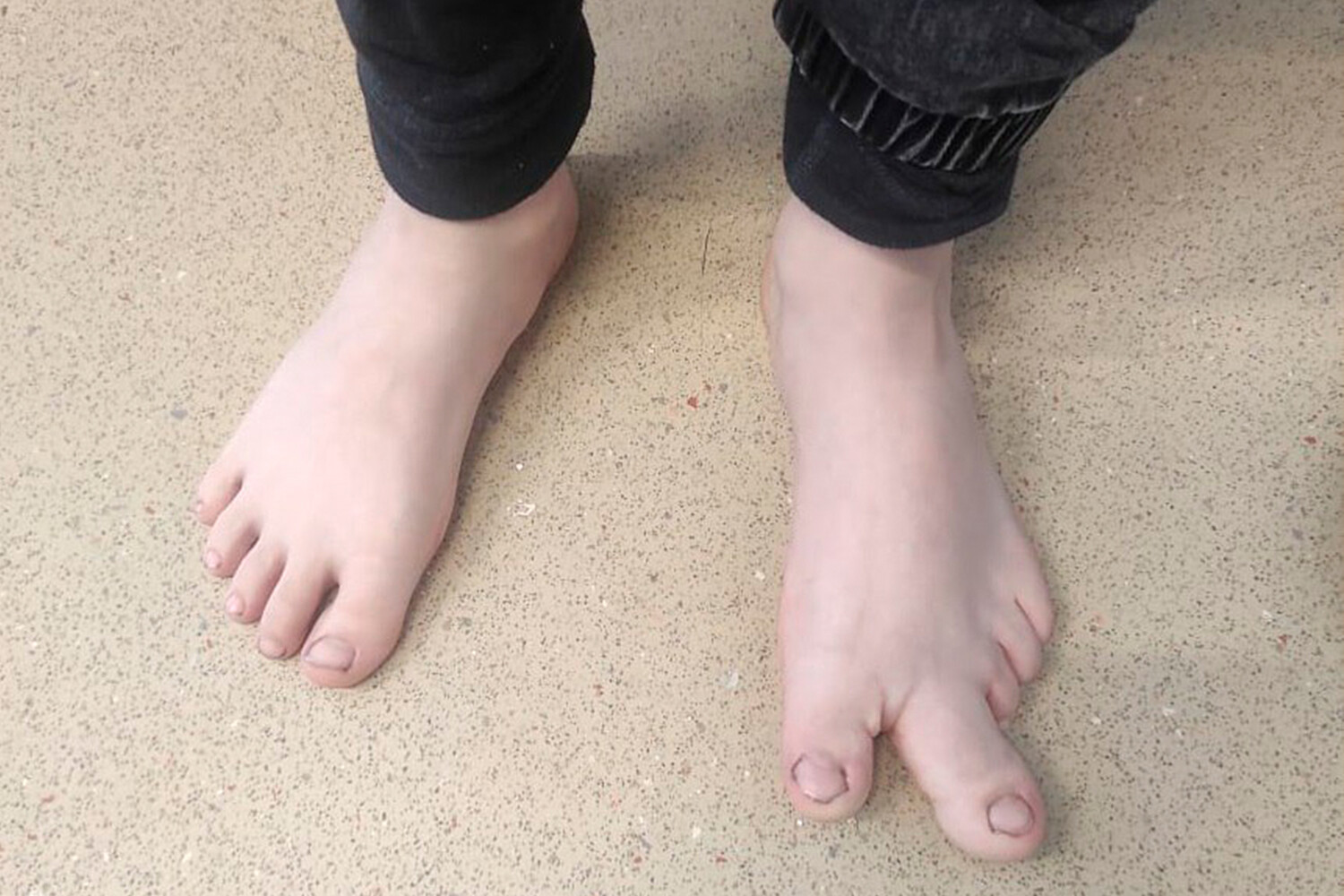 волосатые ноги у ребенка 6 лет фото 89