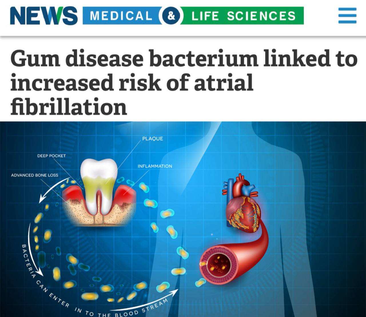 Каждый пропуск чистки зубов увеличивает риск инфаркта | Русская весна