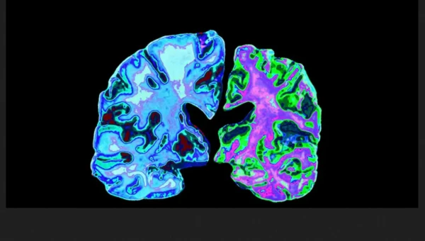 Neurobiology of Stress: Стресс и алкоголь повышают риск болезни Альцгеймера