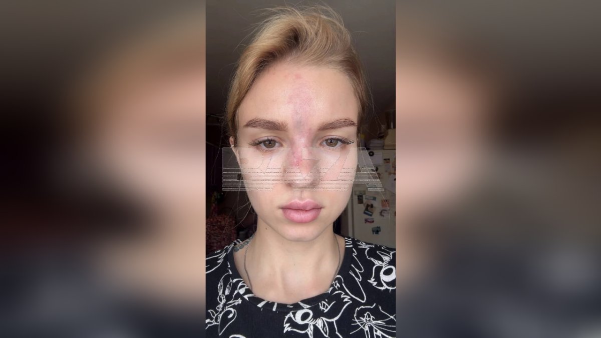 В Уфе пострадавшая от косметолога девушка узнала о своей «смерти»
