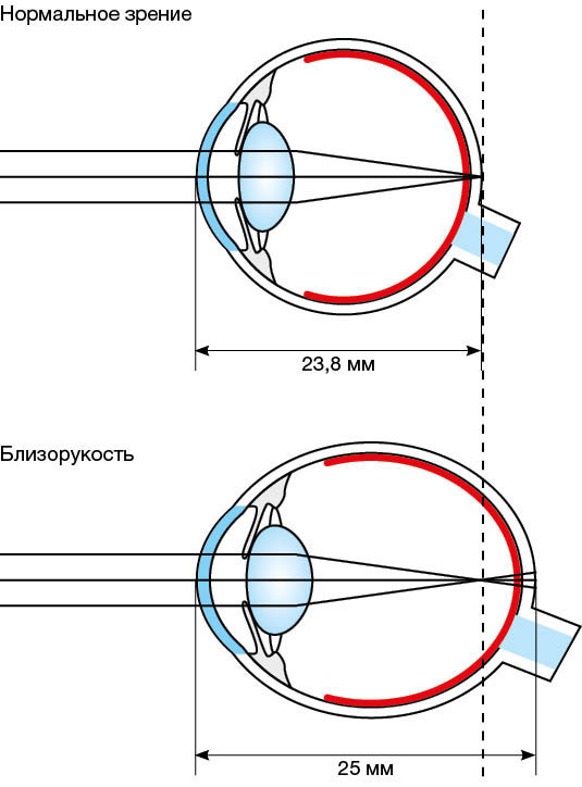 Схема близорукого глаза