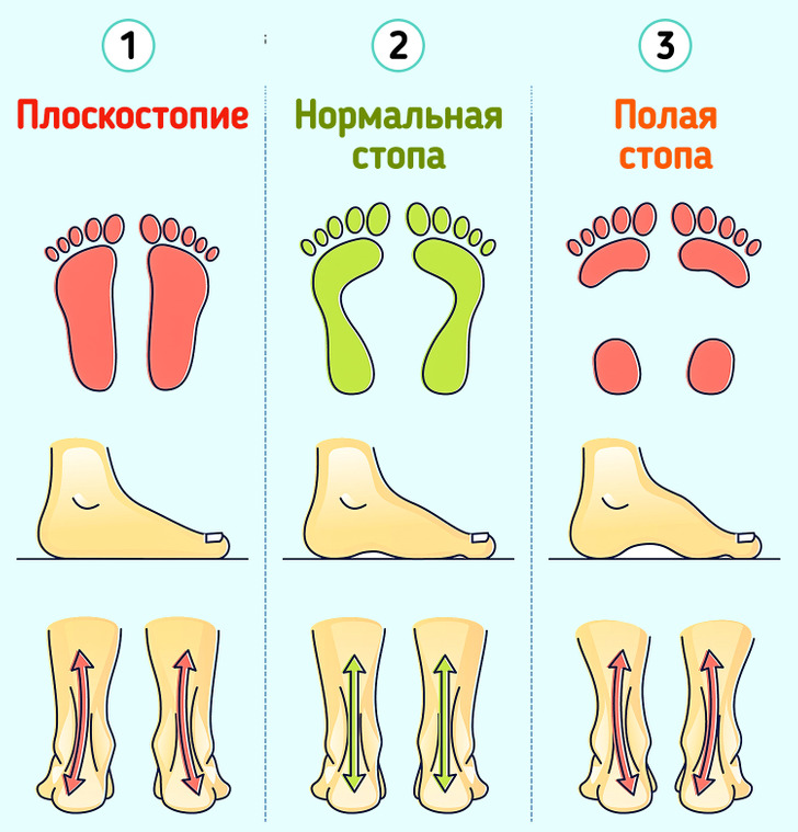 Форма стопы. Типы стопы. Виды стопы. Разновидности стопы. Вертикальная стопа обуви.