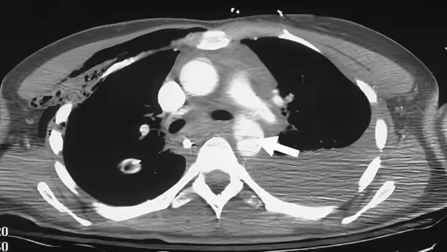 разрыв аорты мкб. врожденный порок сердца двустворчатый аортальный клапан мкб. аневризма брюшной аорты. абдоминальная аневризма аорты. разрыв аорты мкб.