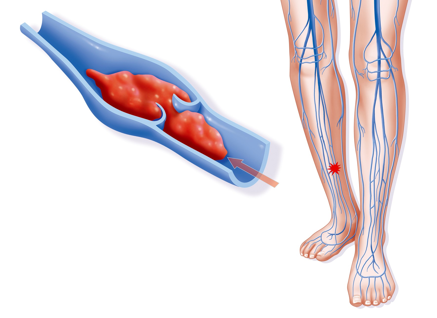 Удаление тромба в ноге