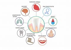  Два визита к стоматологу в год могут спасти от инсульта стоматология НГСП 