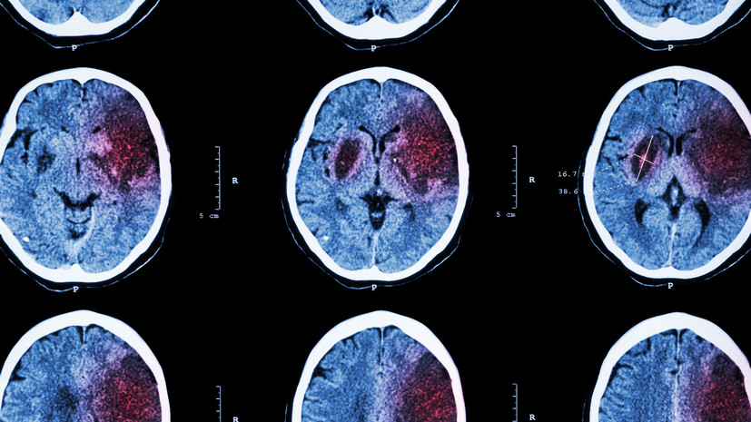 «Позитивный эффект»: российские учёные создали препарат для поздней реабилитации после инсульта