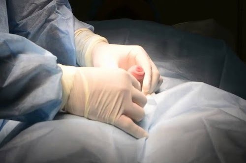 Рези в члене после. Рези в члене после. Нарушение мочеиспускания. Жжение в левом паху у мужчин. Циркумцизио (обрезание крайней плоти при фимозе).