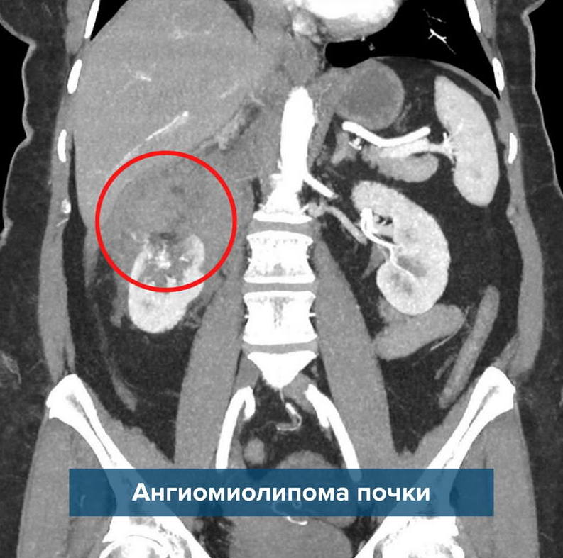 Ангиомиолипома правой. Ангиомиолипома почки кт. Ангиомиолипома почки мрт. Кровоизлияние ангиомиолипома почки кт. Множественные ангиомиолипомы почек кт.