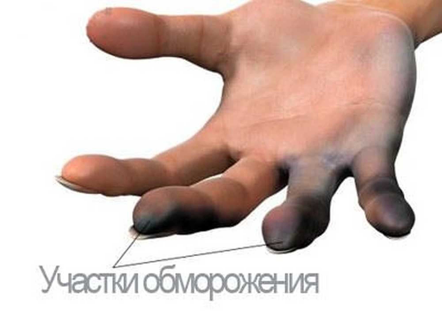 Как выглядит обморожение рук
