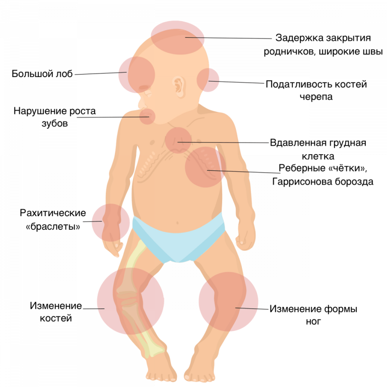 недостаток витамина д симптомы у детей. нехватка витамина д3 симптомы. недостаток витамина д симптомы у детей. недостаток витамина д симптомы у детей. причины дефицита витамина д 3.