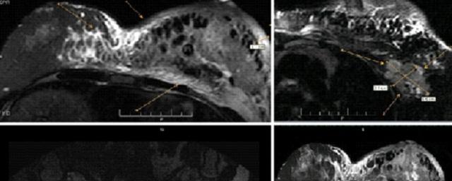 Метастазы распространения схема. Метастаз в подмышечном лимфоузле симптомы. Защита информации от утечки по техническим каналам. Рак молочной железы метастазы в лимфоузлах прогноз. Рак молочной железы метастазы в лимфоузлах прогноз.