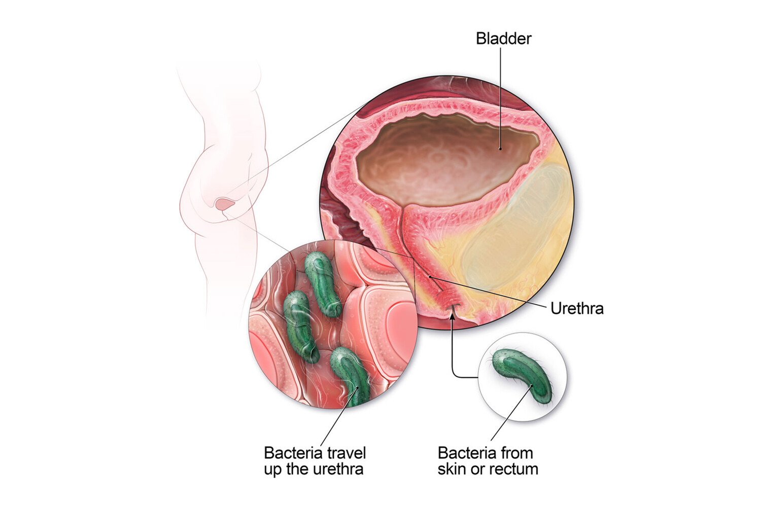 Болезнь мочевого пузыря у женщин лечение. Воспалительные заболевания мочевого пузыря. Цистит воспаление мочевого пузыря. Болезни мочеиспускательного канала.